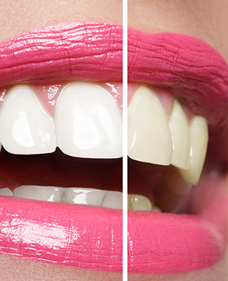 before and after teeth whitening