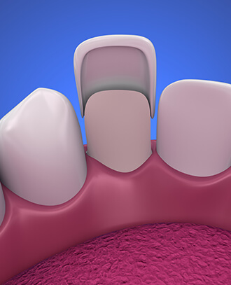 illustration of a dental veneer