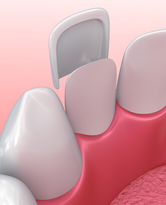 illustration of a dental veneer