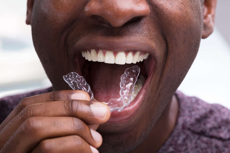 Invisalign, clear aligners, teeth straightening, Invisalign Richmond VA, discreet braces, Norman Obeck Foy Dentistry, dentist Richmond