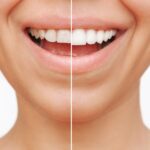 before and after porcelain veneers