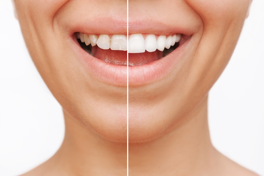 before and after porcelain veneers