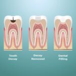 dental filling infographic, dental filling or dental crown