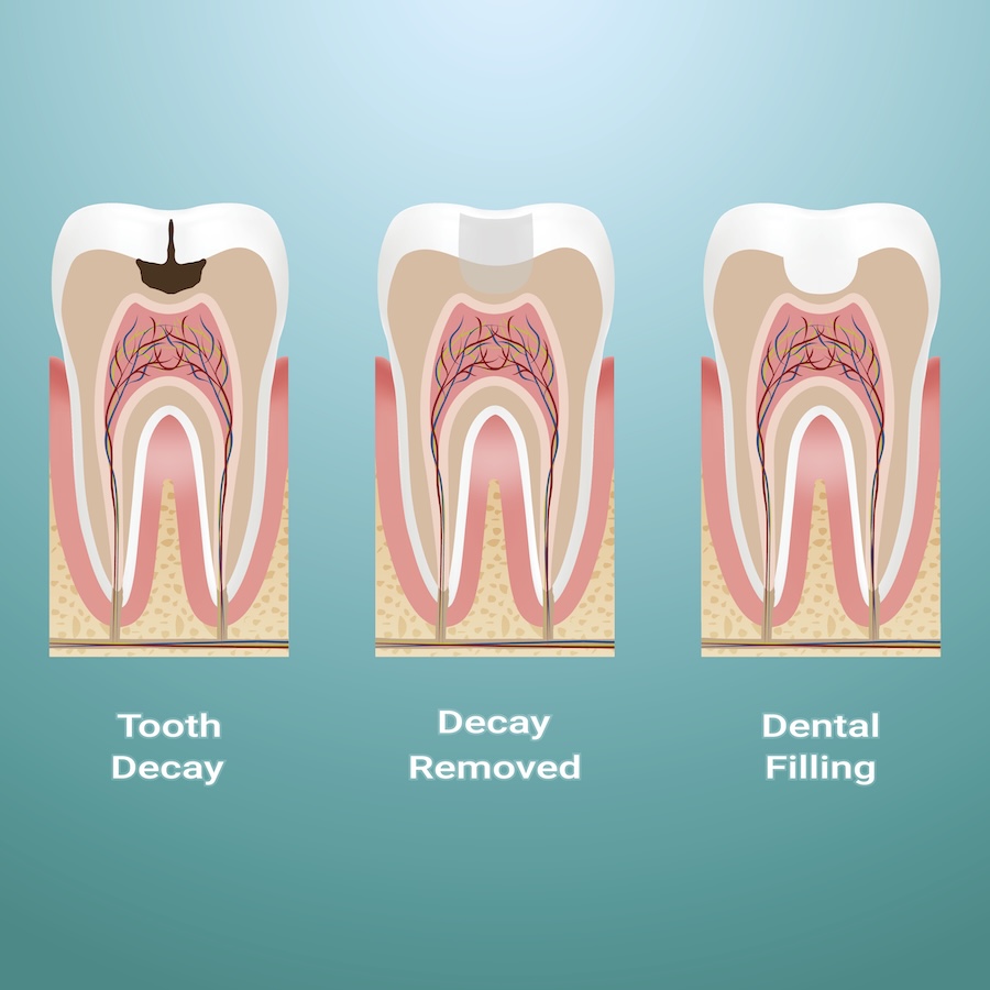 dental filling infographic, dental filling or dental crown
