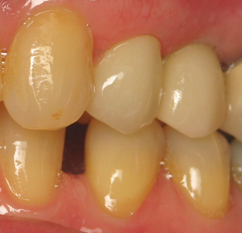 before dental implants