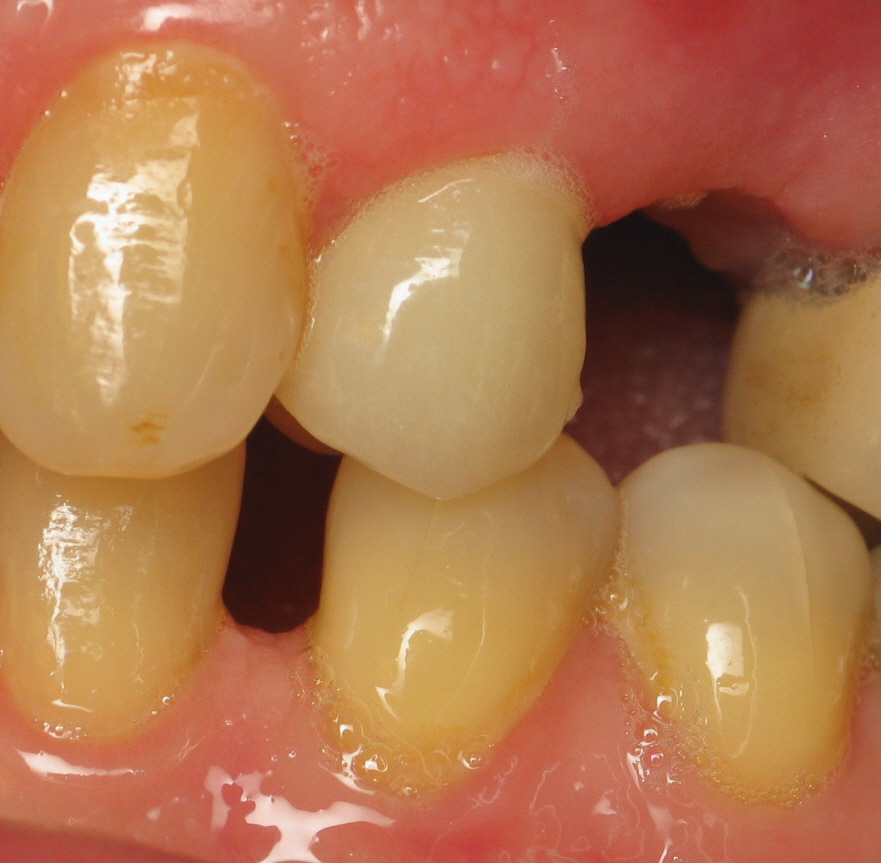 before dental implants
