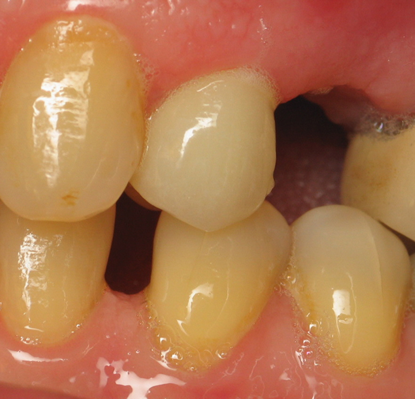 before dental implants