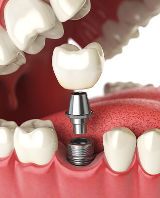 illustration of a dental implant