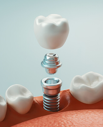 illustration of a dental implant