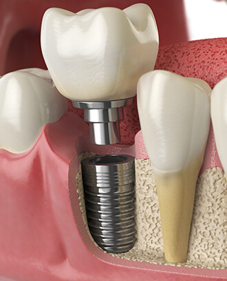illustration of a dental implant