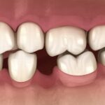 teeth shift due to missing tooth that needs a dental implant, dental implants