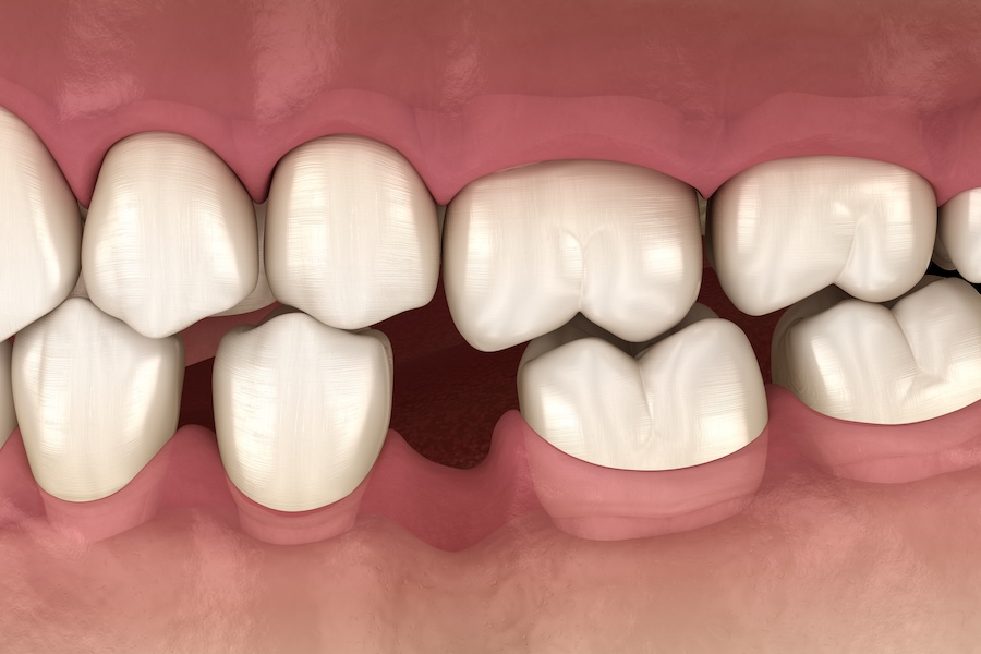 teeth shift due to missing tooth that needs a dental implant, dental implants