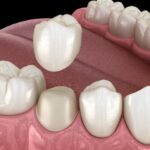 dental crown, loose dental crown replacement