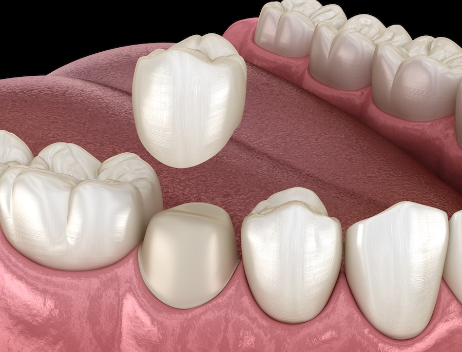 dental crown, loose dental crown replacement